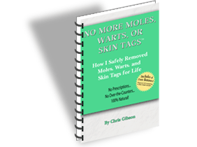 mole removal How To Get Rid Of Moles